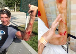 Kurt Hoffman was bitten by a shark while kite surfing off Delray Beach, Fla.