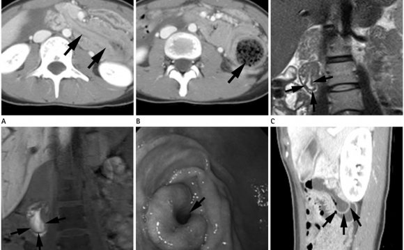 Duodenal diverticulum in a